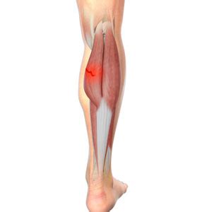 Medial Gastrocnemius Strain Crested Butte, Colorado | Tennis Leg ...