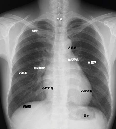 読影の実際 レントゲン写真の読み方・簡単解説