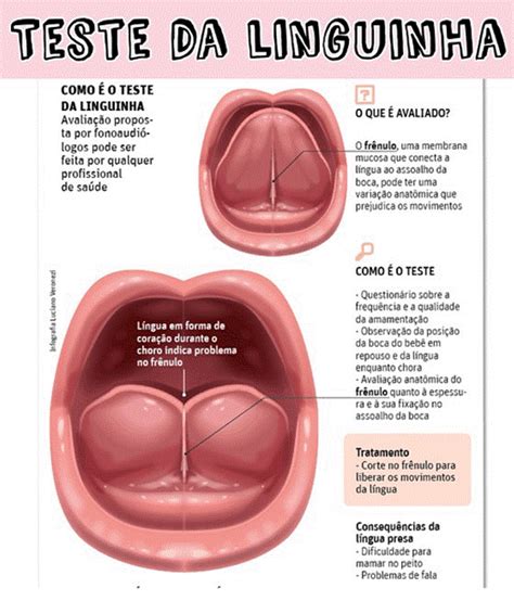 Nutrição e Assuntos Diversos Língua Presa em bebês