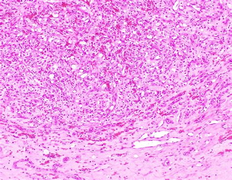 Pathology Outlines Epithelioid Hemangioma Of Bone