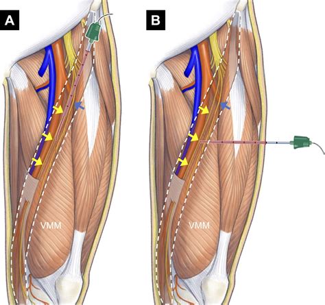 Adductor Canal