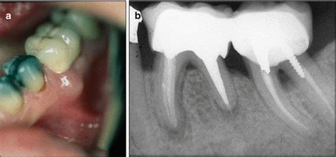 Case Presentations Of Vertical Root Fractures Pocket Dentistry