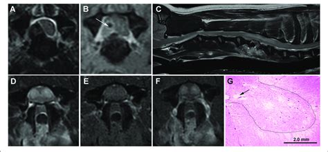 Serial Mri And Neuropathology Of Case A Transverse T W Image