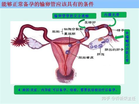 双侧输卵管伞端周围大量粘连，可以自然怀孕吗？ 知乎