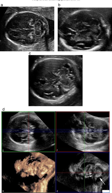 Figure 1 From Diagnostic Imaging Of Posterior Fossa Anomalies In The