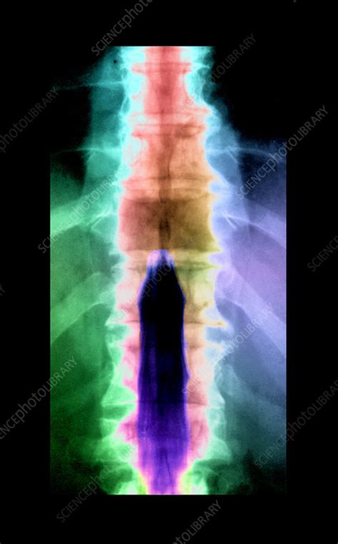 Metastatic Disease Of The Spine Stock Image M1340764 Science