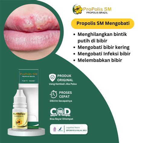 Jual Obat Bintik Putih Di Bibir Fordyce Spots Bibir Bintik Berair