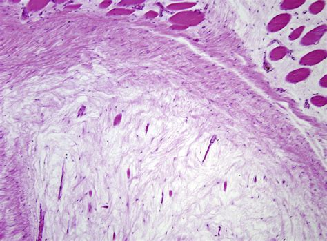 Distinctive Clinicopathologic Features Of The Common Myxoid Soft Tissue