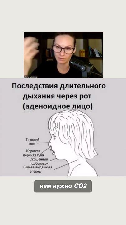 Аденоидное лицо у детей - YouTube
