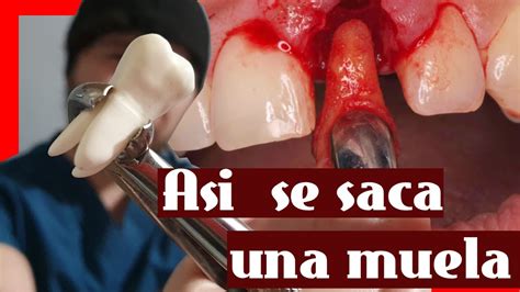 🦷😖así Es Como Se Saca Un Diente Exodoncia 😫🦷reaccionando A Compilado Extracciones N°1 Salud