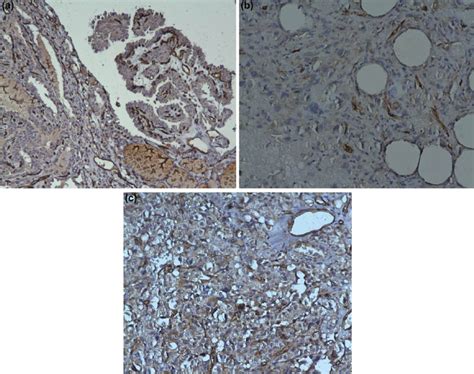 Microvessel Density MVD In Thyroid Tissue A CD31 Positive Vessels