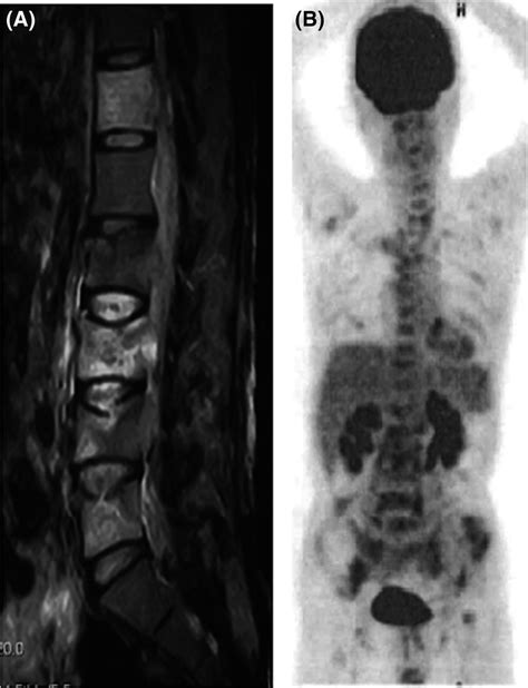 A Sagittal T2‐weighted Magnetic Resonance Imaging Of The Spine A