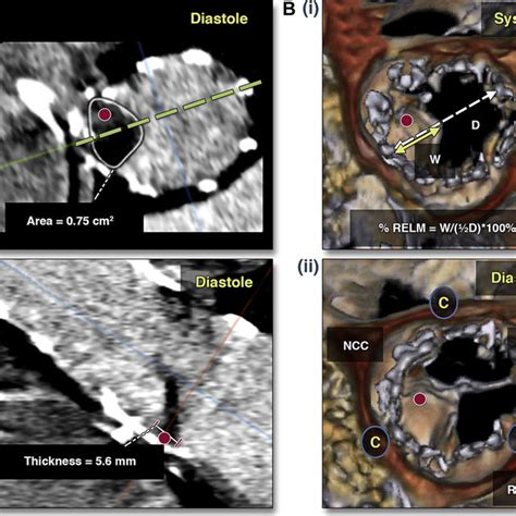 Ct Assessment In A Patient With Severe Pvr After Tavr A B