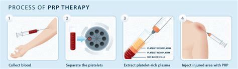 Plasma-Rich-Protein (PRP) Injections – Interventional Spine & Sport Medicine