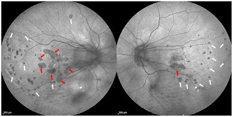 Frontiers Key Multimodal Fundus Imaging Findings To Recognize