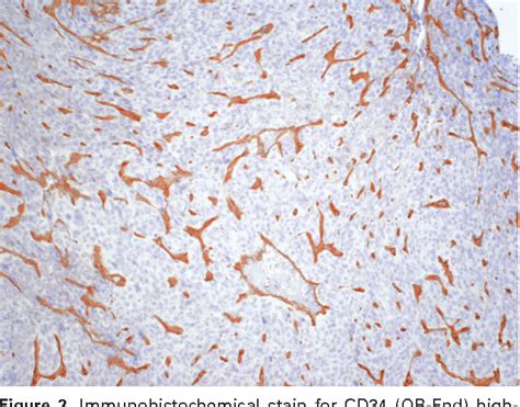 Figure 2 from Metastatic hemangiopericytoma of the skin treated with wide local excision and MGN ...