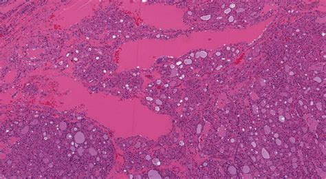 Widely invasive Hurthle cell carcinoma | MyPathologyReport.ca