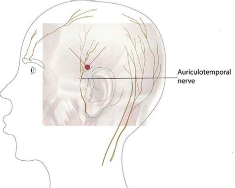 Nerve Blocks - Headache Treatments