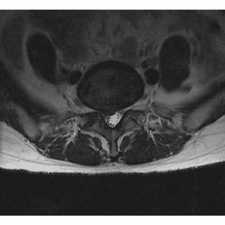 Surgical Procedures A Preoperative T2 Weighted Magnetic Resonance