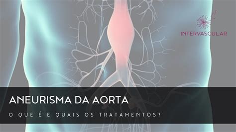 O que é Aneurisma da Aorta e quais os tratamentos Intervascular