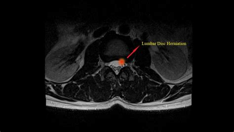 Herniated Disc Thoracic Mri