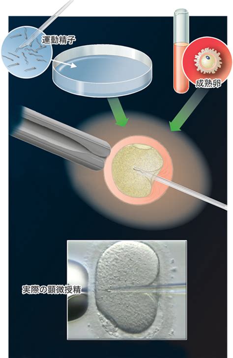 体外受精 顕微授精 さっぽろartクリニックn24