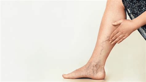 Why Spider Veins Appear And How Do Vein Specialists Treat Them