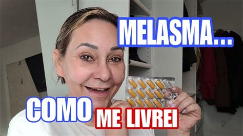 COMO ACABEI O MELASMA EM CASA PASSO A PASSO YouTube