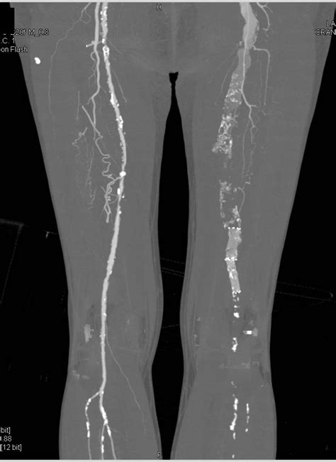 Cta Runoff With Occlusion Of Left Fem Popliteal Graft And Severe