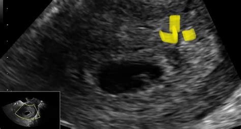 Missed Twin 6 Week Ultrasound BabyCenter