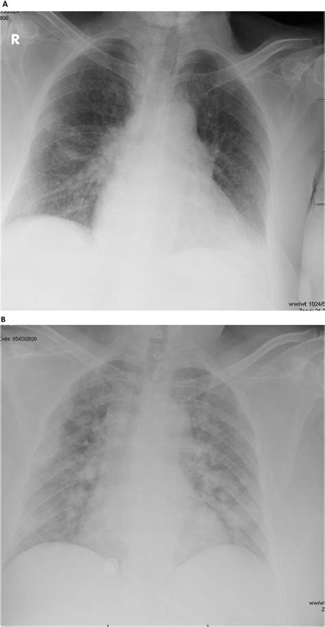 A Portable Anterior Posterior Chest Radiograph Showing Bilateral