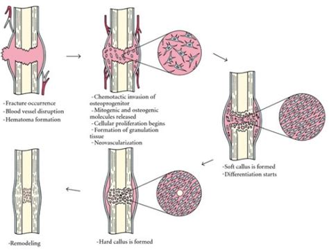 Describe The Process Of Bone Remodeling Orthopaedicsone