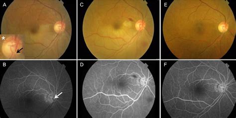 Central Retinal Artery Occlusion Fluorescein Angiography