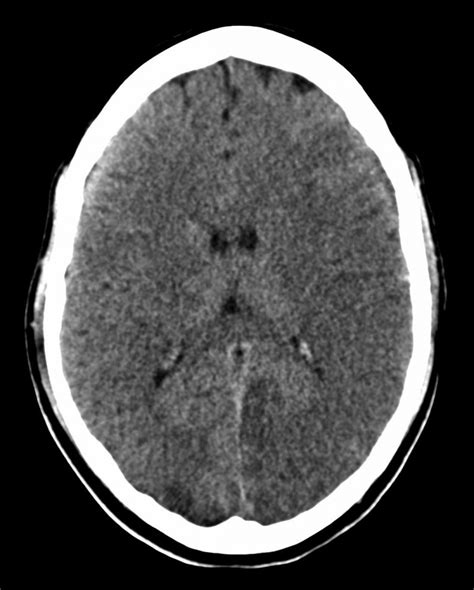 Acute Infarct CT Radiology At St Vincent S University Hospital