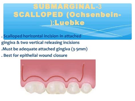 Endodontic Surgery