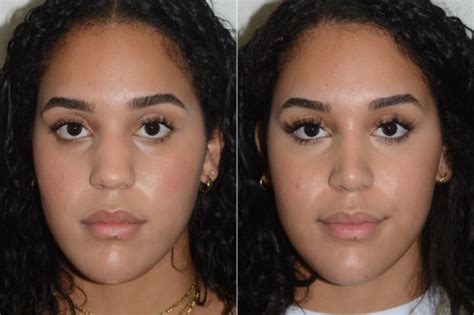 Rhinoplasty Photos Miami Fl Patient 20059