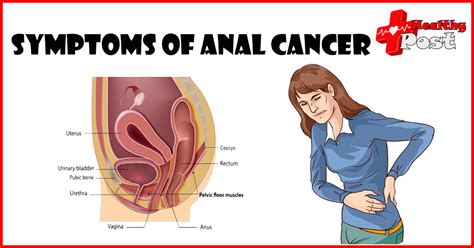 Anal Cancer Symptoms Causes And Treatment Options