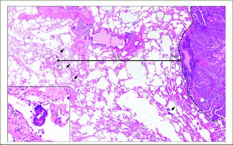 Complex Glandular Pattern Adenocarcinoma Of The Lung With STAS Several