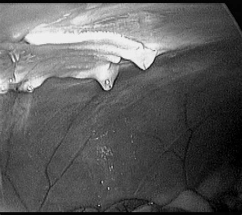 Assessment Of Adhesion Formation To Intra Abdominal Polypropylene Mesh