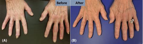 Images Of Clinical Manifestations Of Bazex Syndrome In Patient Before