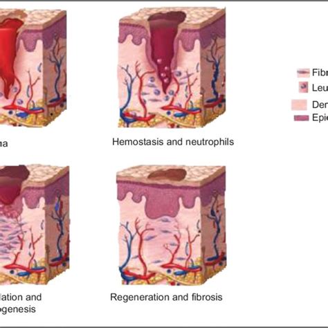 A traumatic degloving wound of the right thigh and buttock. Notes: A... | Download Scientific ...