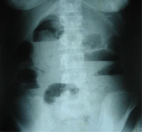 Upright Plain Abdominal X Ray Demonstrating A Small Bowel Obstruction Download Scientific