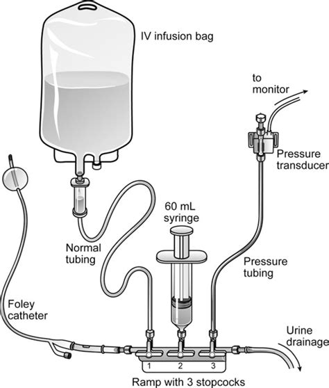 Modified Method For Intrabladder Pressure Monitoring As Described By