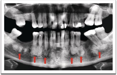 Paget Disease Pocket Dentistry