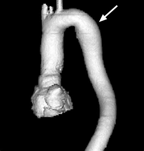 Multidetector Ct Of Thoracic Aortic Aneurysms Radiographics