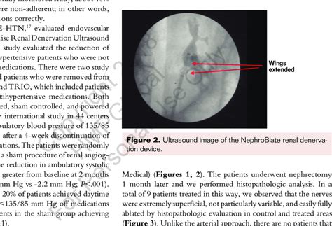 The Nephroblate Renal Denervation Device Download Scientific Diagram