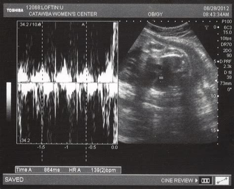 Ultrasound (30 weeks) | Philip, Leslie & Kayli