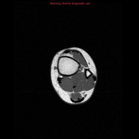 Tibial Nerve Sheath Tumor Image Radiopaedia Org