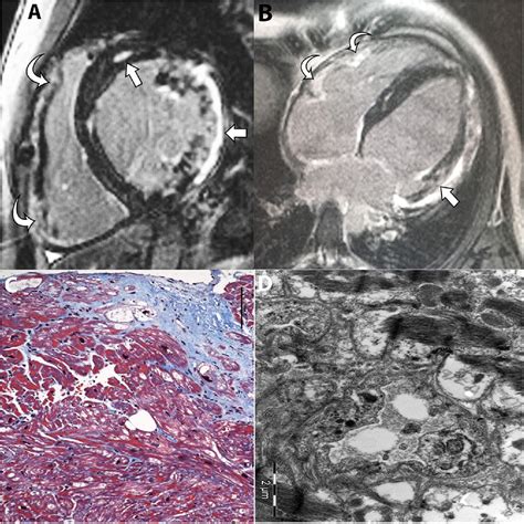 Extensive Right Ventricular Scarring On Cardiac Mri In Danons