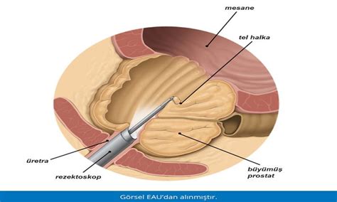 Yi Huylu Prostat B Y Mesi Urolojihakkindacom